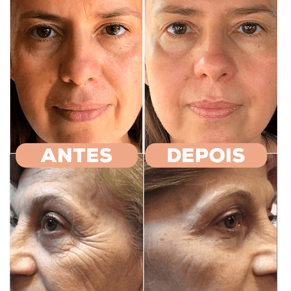 Kit Adesivos Antirrugas NewSkin© (Testa, Olhos, Sorriso, Pescoço e Colo)
