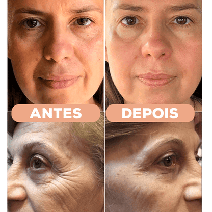 Kit Adesivos Antirrugas NewSkin© (Testa, Olhos, Sorriso, Pescoço e Colo)